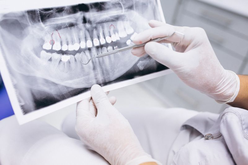 rata-succes-implant-dentar