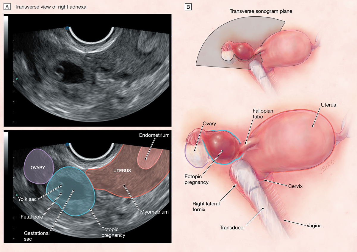 Sarcina extrauterina: Cauze, simptome, definitii