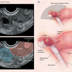 Sarcina extrauterina: Cauze, simptome, definitii